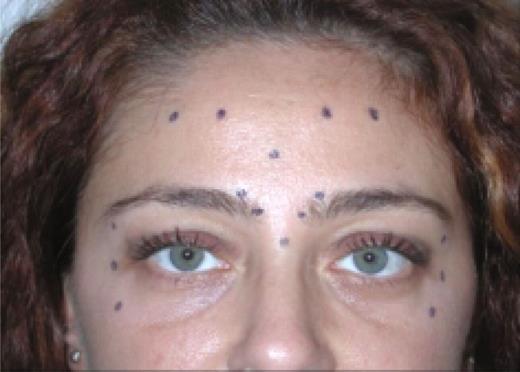 Figure 2 - Injection sites for botulinum toxin.