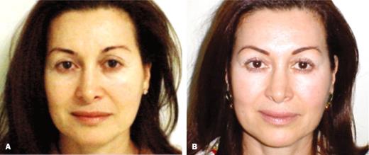 Figure 3 - A, Pretreatment view of a 43-year-old woman with brow asymmetry. B, Posttreatment view of eyebrows 2 weeks after Toxin treatments injections.