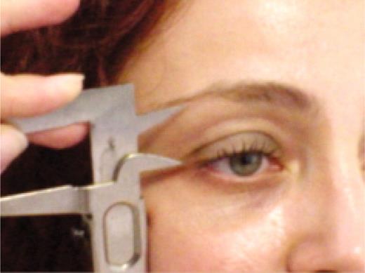 Figure 1 - Measurement of eyebrow height with a caliper.