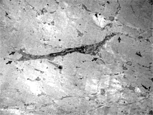 Figure 1. Electron micrograph of an inactive fibrocyte (F) in the culture media–injected site at the fourth month (original magnification, × 5000).