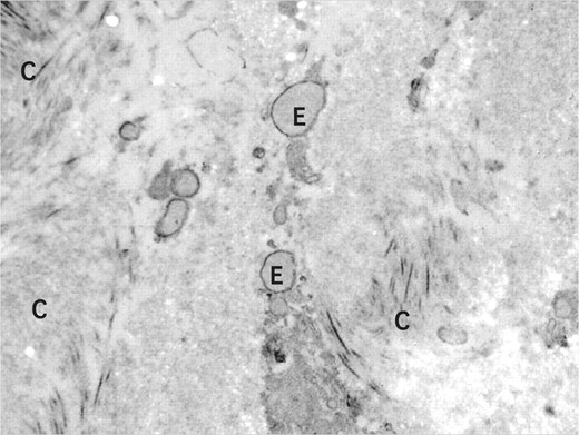 Figure 2. Elastin material (E) amongst collagen fibrils (C) in the hyaluronic acid matrix and fibroblast mixture–injected site at the eighth month (original magnification, × 8000).