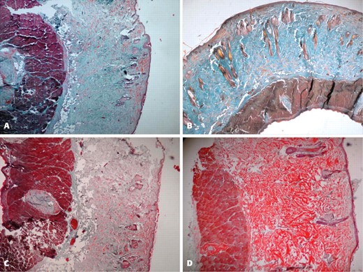 Figure 3. A, Micrograph from cross-sectioned skin of the medium-injected site at the eighth month. B, Micrograph from cross-sectioned skin of hyaluronic acid–injected site at the eighth month. C, Micrograph from cross-sectioned skin of fibroblast mixture–injected site at the eighth month. D, Micrograph from cross-sectioned skin of hyaluronic acid matrix and fibroblast mixture–injected site at the eighth month (original magnification, × 5000).