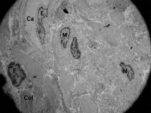 Figure 4. Colonization (Col) of blood vessel–forming macrophages (M) in hyaluronic acid matrix–injected site at the fourth month (original magnification, ×5000). Ca, capillary; E, endothelial cell; F, fibroblast.