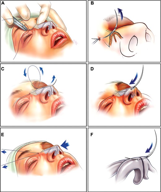 Figure 2 - Surgical steps of the procedure. (A, B) A curved, double-sided needle with a free 3/0 polypropylene thread attached at its middle portion is introduced horizontally to the subcutaneous tissue and stitched through the glabellar periosteum. The needle is pushed along its traced outline; it is extracted from the skin only partially at the other side of the glabella (C). Following the same entry stitch by the opposite sharp end, the needle is pushed vertically down toward the tip in a subcutaneous plane, partially exiting through the skin overlying the most prominent part of the ipsilateral lower lateral cartilage (LLC) (D). Turning back horizontally, the needle is then inserted symmetrically through both LLC (E); the final exit stitch is carried out vertically upward, in the direction of the entry stitch through the initial incision (F). The LLC are then anchored to the glabellar periosteum using both ends of the thread.