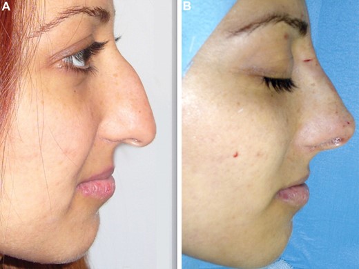 Figure 3 - (A) A 24-year-old woman who presented with a heavy nasal hump. (B) The masking effect of the suspension suture is shown immediately postoperatively.  Minimally invasive rhinoplasty with the shuttle lifting technique.