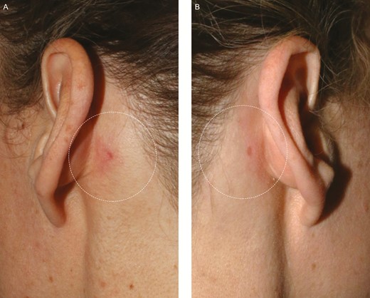 Figure 1. The postauricular regions where skin punch biopsies were performed 3 months earlier on a 38-year-old female patient. (A) On the left side, where only FXD laser treatment was performed, there is a triangle of redness around the punch biopsies. (B) On the right side, where the topical nanofat biocrème and FXD laser treatments were performed, very little surrounding redness other than the punch biopsy is observed. FXD, fractional laser.