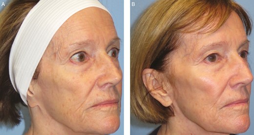 Figure 2.(A) A 72-year-old female patient with a Fitzpatrick type II skin type before fractional laser and topical nanofat biocrème treatment. (B) The patient 3 months after treatment, showing a 1-point wrinkle improvement, a 1-point improvement in nasolabial folds, and a 5-point improvement in overall skin texture.