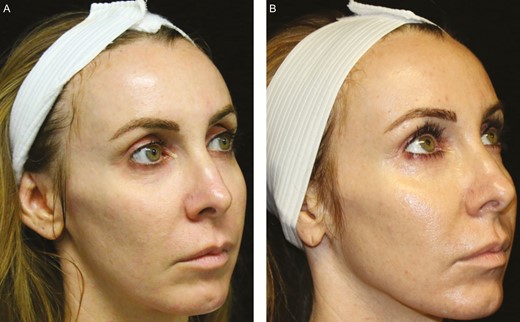 Figure 3.(A) A 39-year-old female patient with a Fitzpatrick type II skin type before fractional laser and topical nanofat biocrème treatment. (B) The patient 3 months after treatment, showing a 1-point wrinkle improvement, a 1-point improvement in nasolabial folds, and a 3-point improvement in overall skin texture.