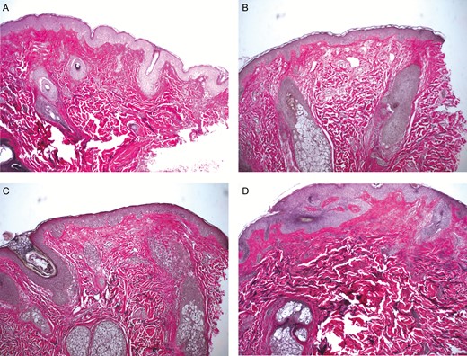 Figure 4. Pretreatment punch skin biopsy of 38-year-old female patient’s (A) left postauricular and (B) right postauricular regions. Histologic examination revealed that pretreatment punch biopsies of left and right postauricular skin showed similar features. Punch biopsy taken 3 months after treatment of the patient’s (C) left postauricular skin, which received only FXD treatment, and (D) right postauricular skin, which received FXD treatment plus topical nanofat biocrème. Blind histologic examination identified greater numbers of new elastin fibers as well as a slight increase in the thickness of the epidermis on the skin in the area treated with topical nanofat biocrème and FXD (D). FXD, fractional laser.