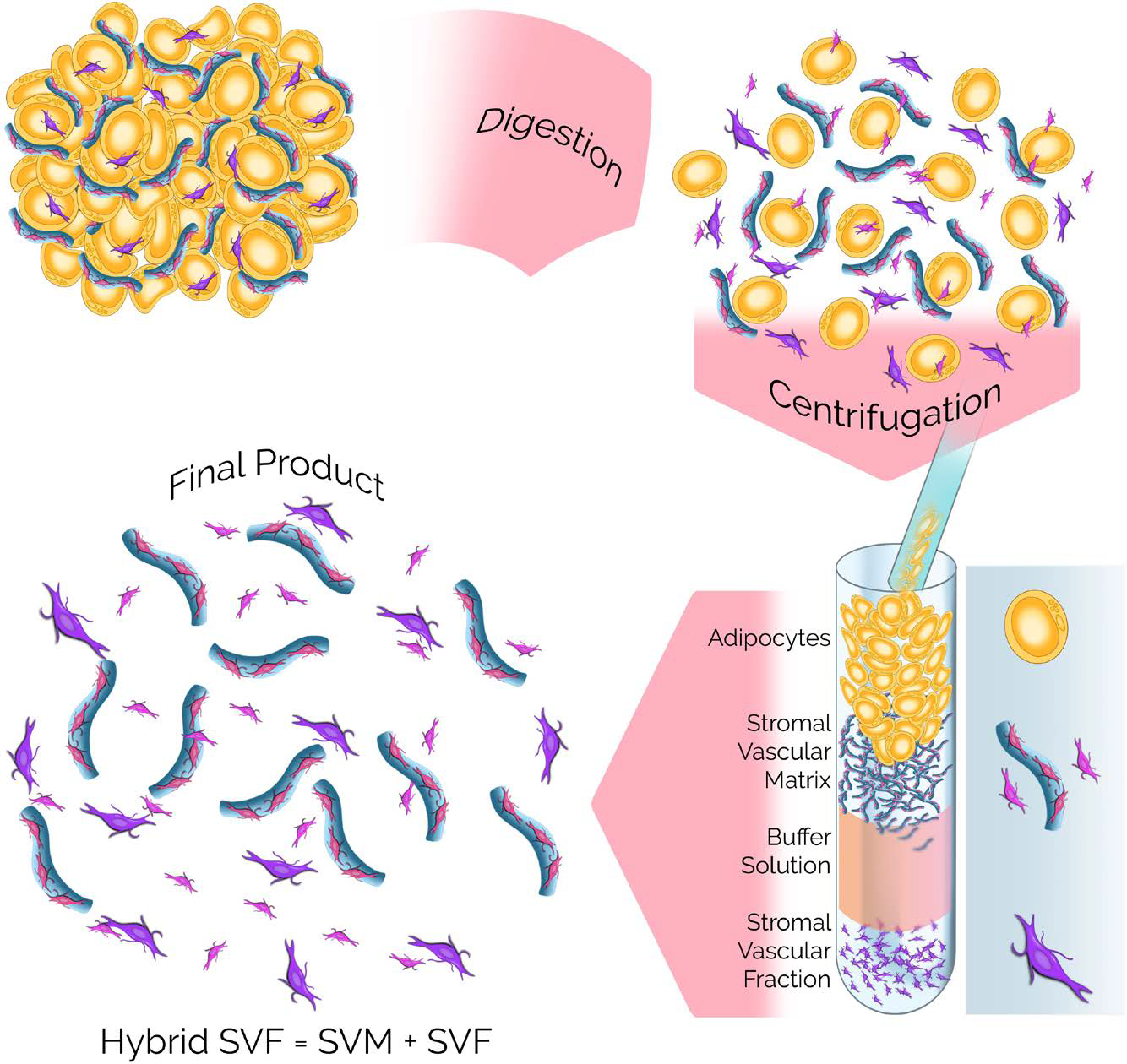 Fig. 1.: Schematic illustrations of hybrid-SVF. After mechanical digestion and centrifugation stages, adipose tissue was obtained in four different layers: adipocytes, SVM, Buffer solution, and M-SVF. Hybrid-SVF is a highly concentrated regenerative cell cocktail made up of a layer of stromal vascular matrix in the middle and stromal vascular fraction in the bottom.