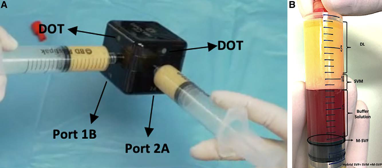 Fig. 2.: Mechanical SVF isolation with SVF kit from Lipoaspirated fat tissue and configuration of different layers of processed input. A, Mechanical isolation SVF kit process. B, After centrifugation, the top oil and fat layers (the light color part of the adipose tissue) are called DLs. The very bottom ECM-rich portion of the adipose tissue is called SVM, and the SVF over the top of the cell-adhesive gasket is called M-SVF. Hybrid-SVF is the fusion of concentrated tissue-based stromal vascular fraction, which is called SVM, with cellular-based mechanically isolated SVF materials.