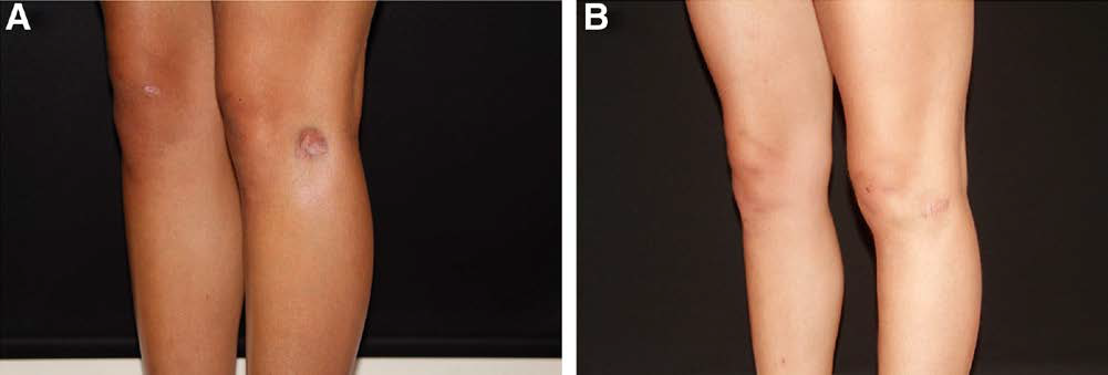 Fig. 4.: Clinical case of hybrid-SVF technology: a 38-year-old female patient presented with a complaint of a depressed area on her left knee that happened after an intra-articular steroid injection. 10 mL fat grafting combined with hybrid-SVF injection was applied to the defect area. During her follow-up visits, it was observed that the contour of the fat grafted area remained unchanged even after 6 months postoperative, and the skin quality improved over time. The patient did not require an additional fat grafting session. A, Contour deformity on her left knee after intra-articular injection. B, Postoperative 6-month appearance after 10-mL fat grafting combined with hybrid-SVF.