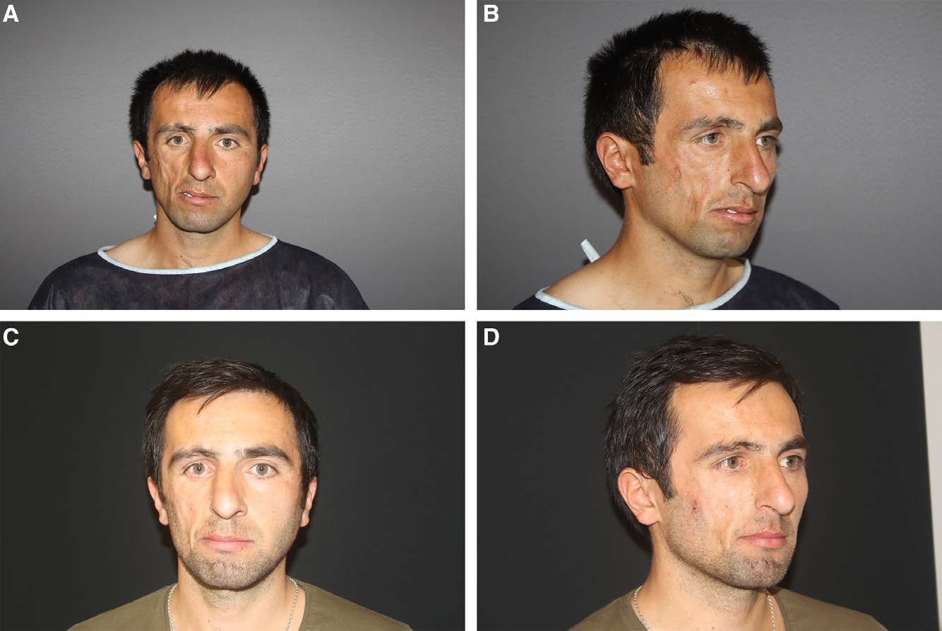 Fig. 5.: Clinical case of hybrid-SVF technology. A 42-year-old male patient with a history of trauma-induced Romberg disease presented with a contour deformity on his right hemifacial area. The extensively scarred recipient bed was loosened via rigotomies, making it suitable for fat grafting; 34-mL fat grafting combined with hybrid-SVF injection was performed. The scarred and atrophic appearance of the right hemifacial area improved significantly. At the postoperative 1-year follow-up visit, it was noted that the fat grafted area preserved its form completely. A and B, History of trauma-induced Romberg disease presented with extensive contour deformity on his right hemifacial area. C and D, Postoperative first-year appearance of the patient after 34 mL of fat grafting combined with hybrid-SVF.