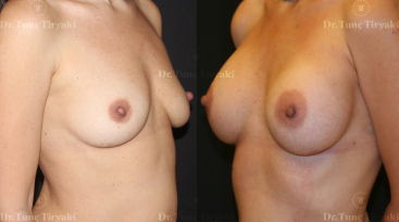 breast-augmantation2