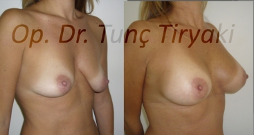breast-augmentation-325cc-anatomical